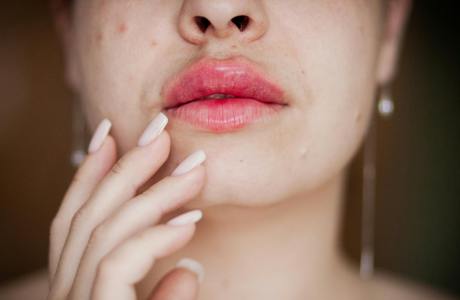 Cold Sores