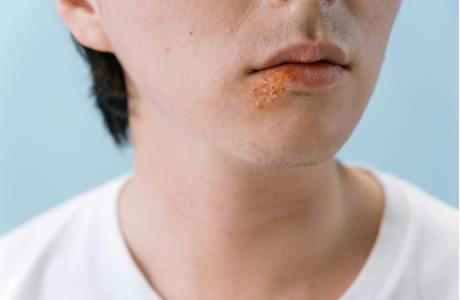Impetigo