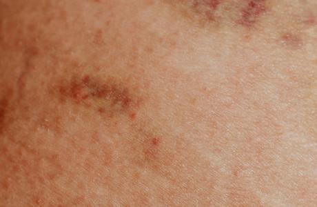 Shingles